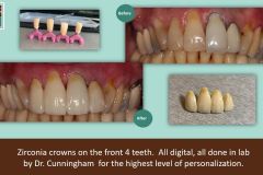 7-10-zirconia-1