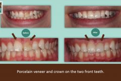 8-9veneer-940x528