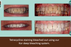 Kor-tetracycline