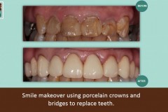 Smile-makeover-1024x574