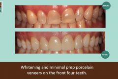 Veneers-940x529