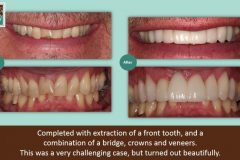 resorption-940x528