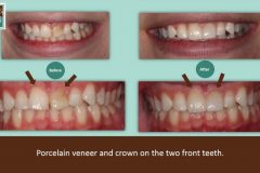 8-9veneer