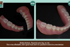 Broken-denture