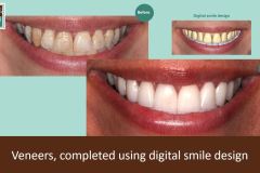 Digital-smile-design