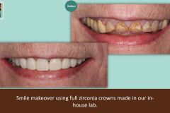 Full-zirconia-upper-makeover