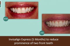 Invisalign-express