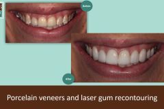 Make-over-gum-recontouring