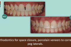 Peg-laterals-and-ortho