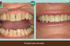 Porcelain-veneers-and-crowns