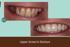 Screw-in-denture-nov21