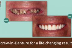 Screw-in-denture-zirc