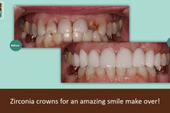 Zirconia-crown-make-over
