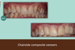 chairside-composite-veneers