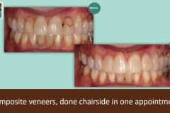 composite-lateral-veneers