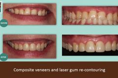 composite-veneer-and-laser