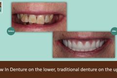 denture-over-screw-in-denture