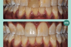 porcelaincrown-before-after