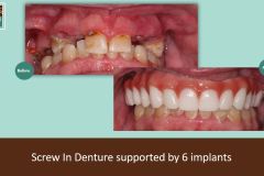 screw-in-denture-oct