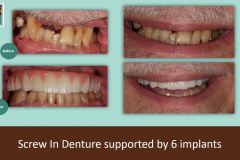 screw-in-denture-pmma