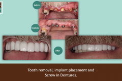 screw-in-dentures