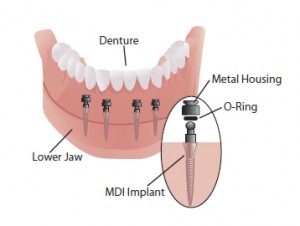 mini dental implants